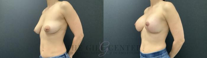 Breast Augmentation Case 707 Before & After Left Side | The Woodlands, TX | The Gill Center for Plastic Surgery and Dermatology