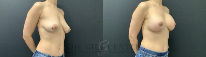 Breast Augmentation Case 707 Before & After Right Side | The Woodlands, TX | The Gill Center for Plastic Surgery and Dermatology