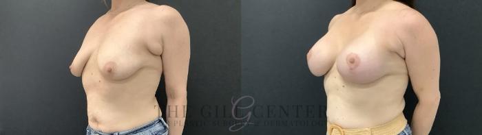 Breast Augmentation Case 708 Before & After Left Side | The Woodlands, TX | The Gill Center for Plastic Surgery and Dermatology