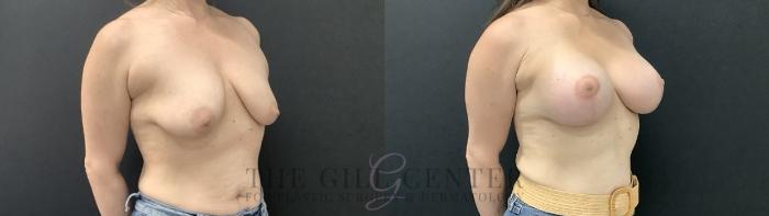 Breast Augmentation Case 708 Before & After Right Side | The Woodlands, TX | The Gill Center for Plastic Surgery and Dermatology