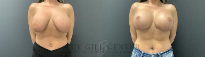 Breast Augmentation Case 709 Before & After Front | The Woodlands, TX | The Gill Center for Plastic Surgery and Dermatology