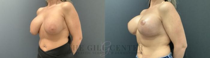 Breast Augmentation Case 709 Before & After Left Side | The Woodlands, TX | The Gill Center for Plastic Surgery and Dermatology