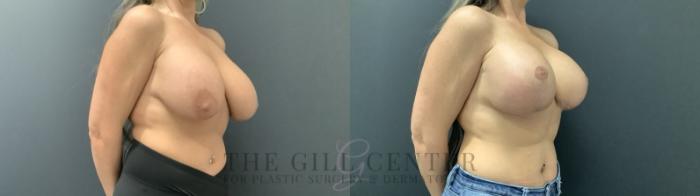 Breast Augmentation Case 709 Before & After Right Side | The Woodlands, TX | The Gill Center for Plastic Surgery and Dermatology