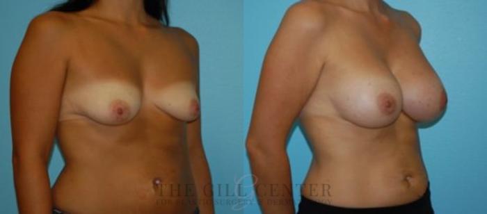 Breast Augmentation Case 71 Before & After Right Oblique | The Woodlands, TX | The Gill Center for Plastic Surgery and Dermatology