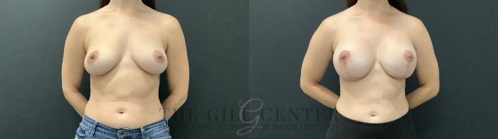 Breast Augmentation Case 710 Before & After Front | The Woodlands, TX | The Gill Center for Plastic Surgery and Dermatology