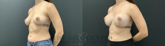 Breast Augmentation Case 710 Before & After Left Side | The Woodlands, TX | The Gill Center for Plastic Surgery and Dermatology