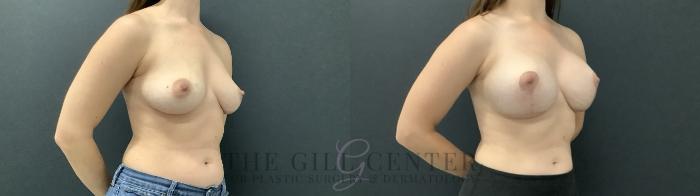 Breast Augmentation Case 710 Before & After Right Side | The Woodlands, TX | The Gill Center for Plastic Surgery and Dermatology