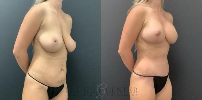 Breast Augmentation Case 712 Before & After Right Side | The Woodlands, TX | The Gill Center for Plastic Surgery and Dermatology
