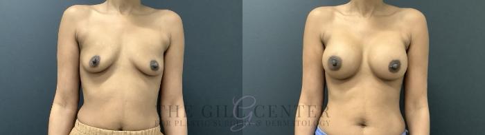 Breast Augmentation Case 713 Before & After Front | The Woodlands, TX | The Gill Center for Plastic Surgery and Dermatology