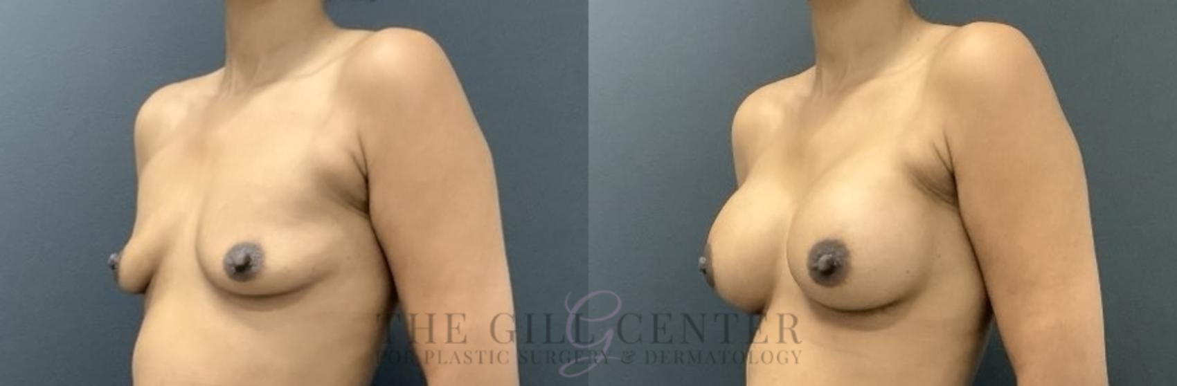 Breast Augmentation Case 713 Before & After Left Side | The Woodlands, TX | The Gill Center for Plastic Surgery and Dermatology