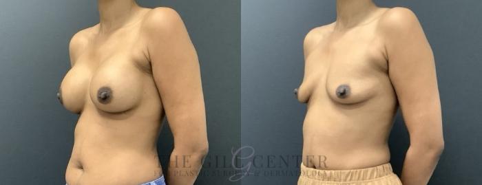 Breast Augmentation Case 713 Before & After Left Side | The Woodlands, TX | The Gill Center for Plastic Surgery and Dermatology