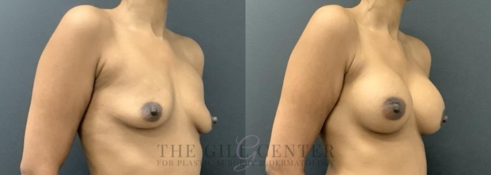 Breast Augmentation Case 713 Before & After Right Side | The Woodlands, TX | The Gill Center for Plastic Surgery and Dermatology