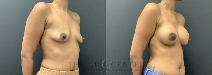 Breast Augmentation Case 713 Before & After Right Side | The Woodlands, TX | The Gill Center for Plastic Surgery and Dermatology