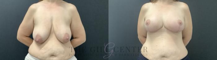 Breast Augmentation Case 714 Before & After Front | The Woodlands, TX | The Gill Center for Plastic Surgery and Dermatology