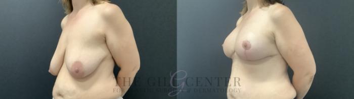 Breast Augmentation Case 714 Before & After Left Side | The Woodlands, TX | The Gill Center for Plastic Surgery and Dermatology