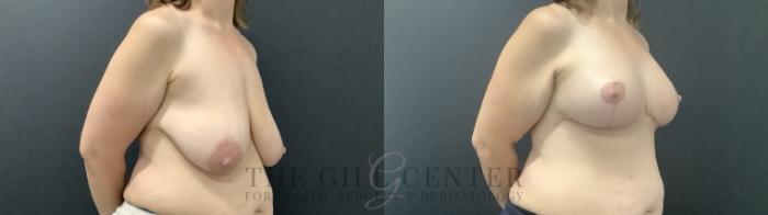 Breast Augmentation Case 714 Before & After Right Side | The Woodlands, TX | The Gill Center for Plastic Surgery and Dermatology