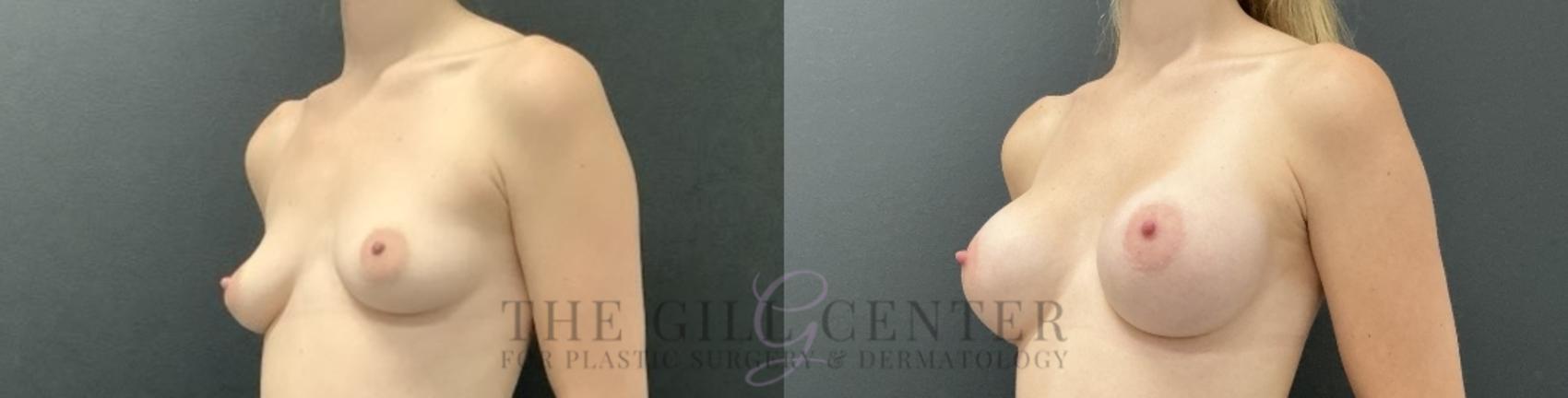 Breast Augmentation Case 725 Before & After Left Oblique | The Woodlands, TX | The Gill Center for Plastic Surgery and Dermatology