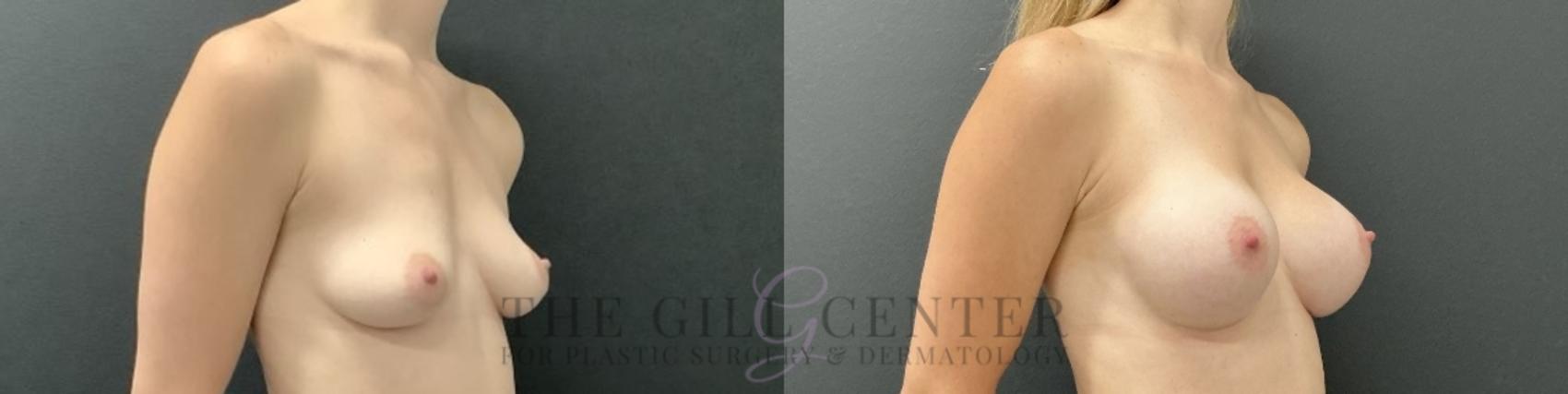 Breast Augmentation Case 725 Before & After Right Oblique | The Woodlands, TX | The Gill Center for Plastic Surgery and Dermatology