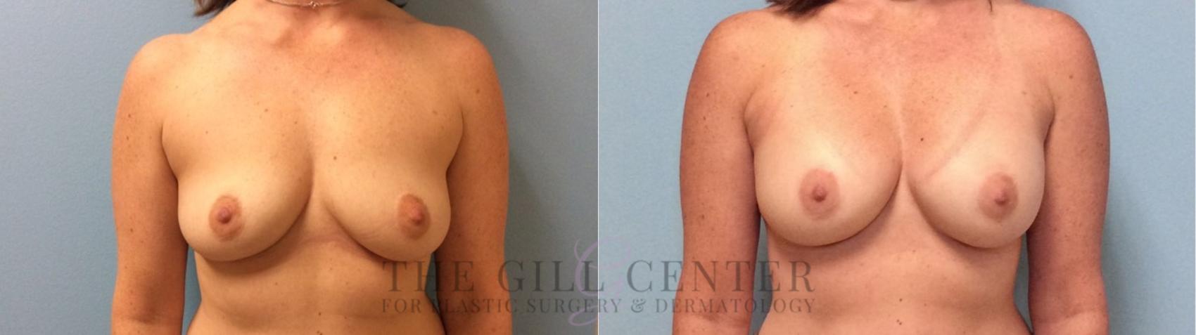 Breast Augmentation Case 74 Before & After Front | The Woodlands, TX | The Gill Center for Plastic Surgery and Dermatology