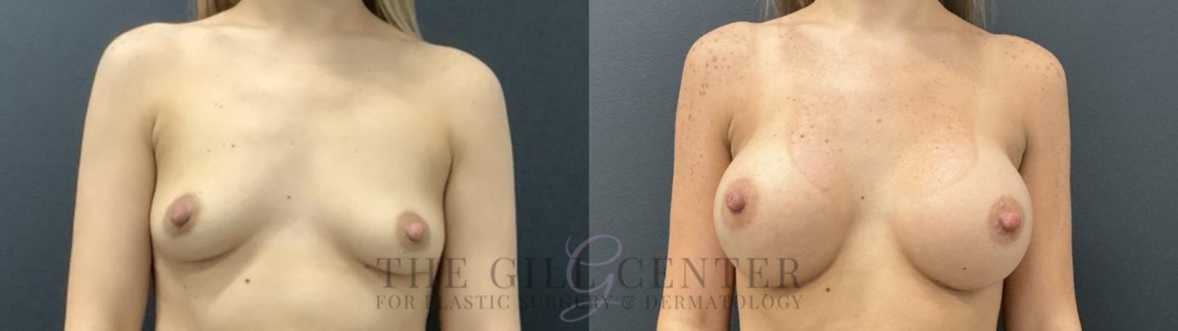 Breast Augmentation Case 740 Before & After Front | The Woodlands, TX | The Gill Center for Plastic Surgery and Dermatology