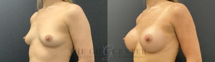 Breast Augmentation Case 740 Before & After Left Oblique | The Woodlands, TX | The Gill Center for Plastic Surgery and Dermatology