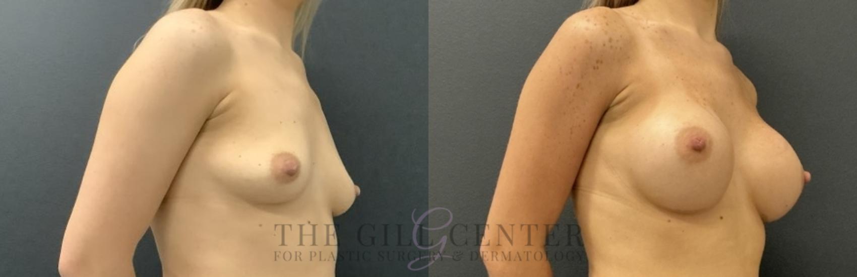 Breast Augmentation Case 740 Before & After Right Oblique | The Woodlands, TX | The Gill Center for Plastic Surgery and Dermatology