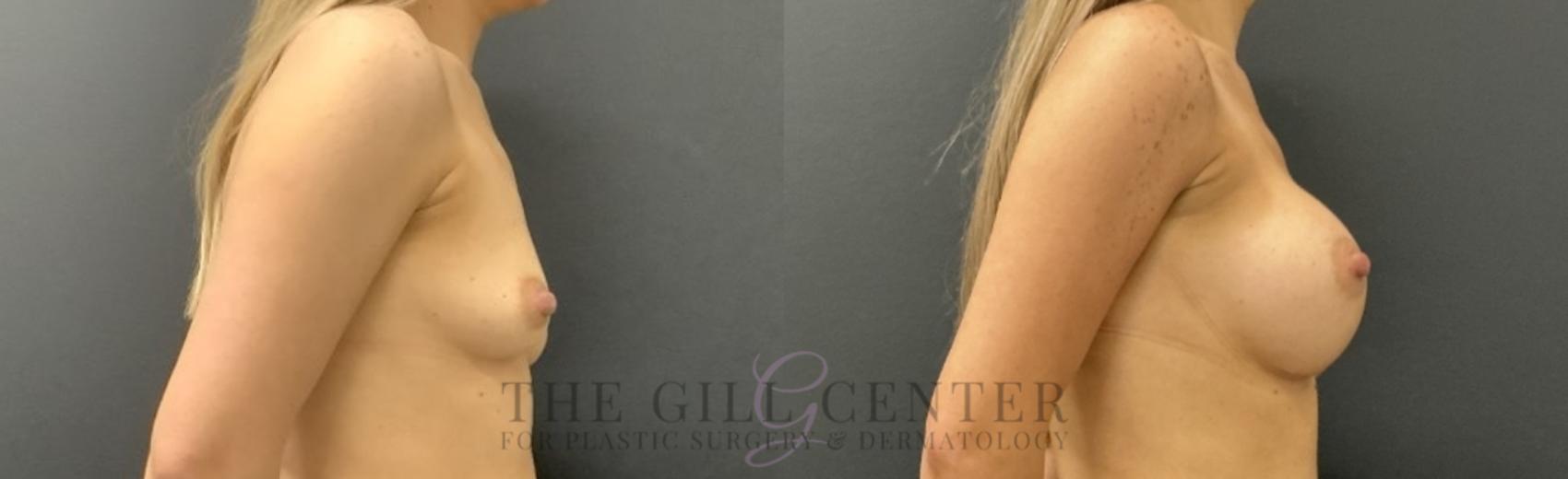 Breast Augmentation Case 740 Before & After Right Side | The Woodlands, TX | The Gill Center for Plastic Surgery and Dermatology