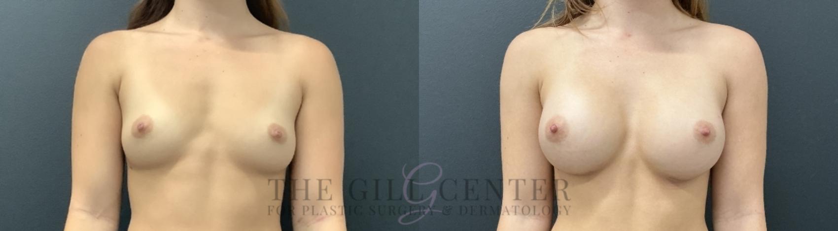 Breast Augmentation Case 742 Before & After Front | The Woodlands, TX | The Gill Center for Plastic Surgery and Dermatology