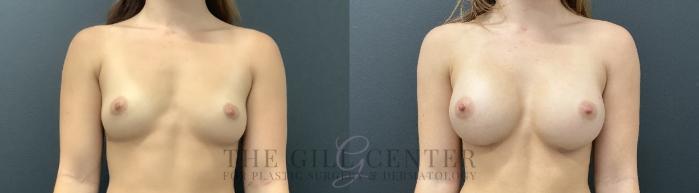 Breast Augmentation Case 742 Before & After Front | The Woodlands, TX | The Gill Center for Plastic Surgery and Dermatology