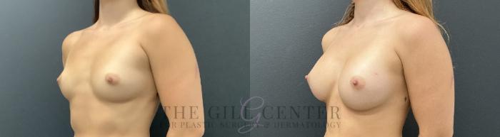 Breast Augmentation Case 742 Before & After Left Oblique | The Woodlands, TX | The Gill Center for Plastic Surgery and Dermatology