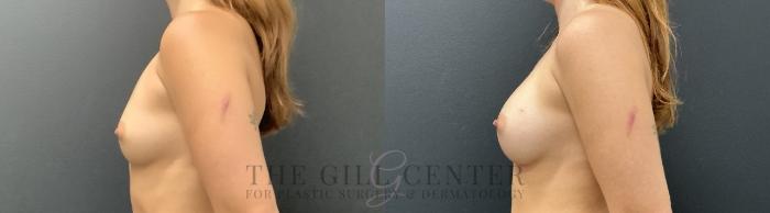 Breast Augmentation Case 742 Before & After Left Side | The Woodlands, TX | The Gill Center for Plastic Surgery and Dermatology
