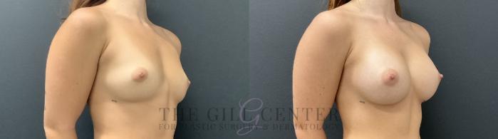 Breast Augmentation Case 742 Before & After Right Oblique | The Woodlands, TX | The Gill Center for Plastic Surgery and Dermatology