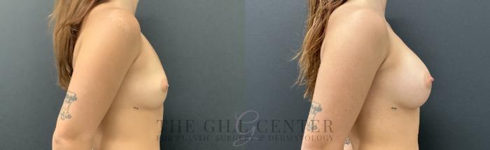 Breast Augmentation Case 742 Before & After Right Side | The Woodlands, TX | The Gill Center for Plastic Surgery and Dermatology