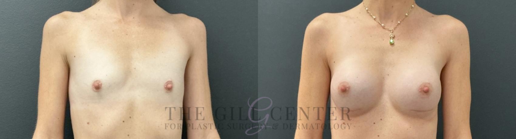 Breast Augmentation Case 755 Before & After Front | The Woodlands, TX | The Gill Center for Plastic Surgery and Dermatology