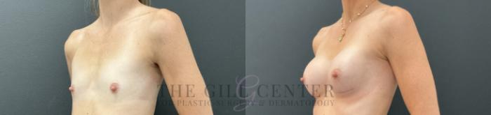 Breast Augmentation Case 755 Before & After Left Oblique | The Woodlands, TX | The Gill Center for Plastic Surgery and Dermatology