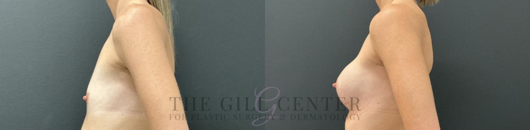 Breast Augmentation Case 755 Before & After Left Side | The Woodlands, TX | The Gill Center for Plastic Surgery and Dermatology