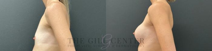 Breast Augmentation Case 755 Before & After Left Side | The Woodlands, TX | The Gill Center for Plastic Surgery and Dermatology