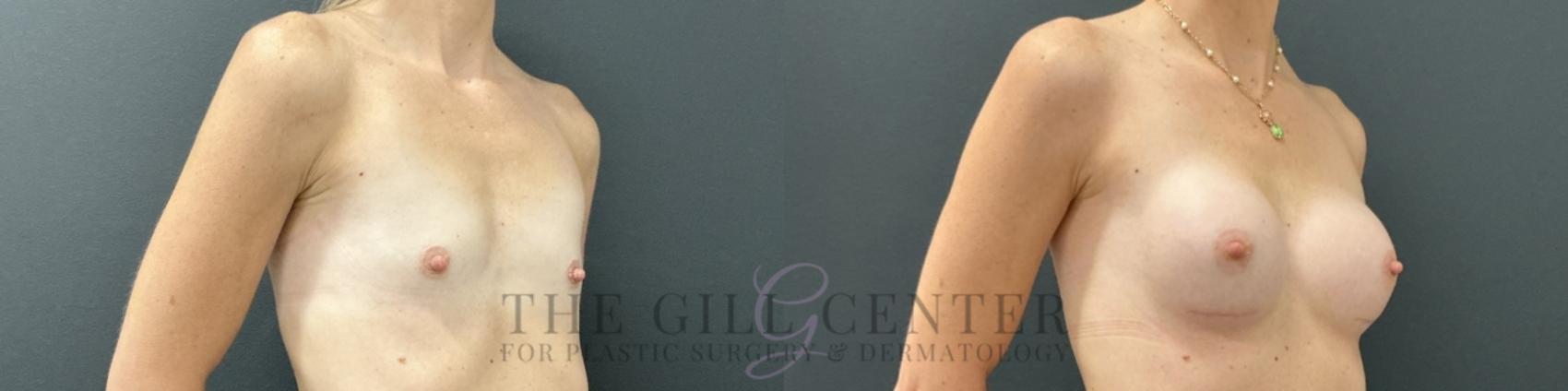 Breast Augmentation Case 755 Before & After Right Oblique | The Woodlands, TX | The Gill Center for Plastic Surgery and Dermatology