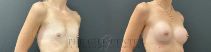 Breast Augmentation Case 755 Before & After Right Oblique | The Woodlands, TX | The Gill Center for Plastic Surgery and Dermatology