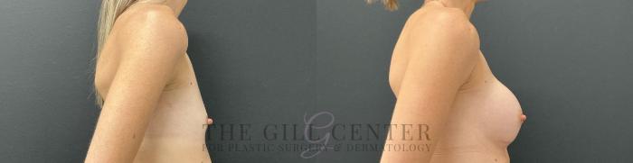 Breast Augmentation Case 755 Before & After Right Side | The Woodlands, TX | The Gill Center for Plastic Surgery and Dermatology