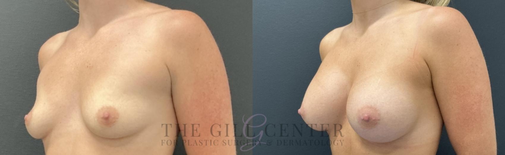 Breast Augmentation Case 757 Before & After Left Oblique | The Woodlands, TX | The Gill Center for Plastic Surgery and Dermatology