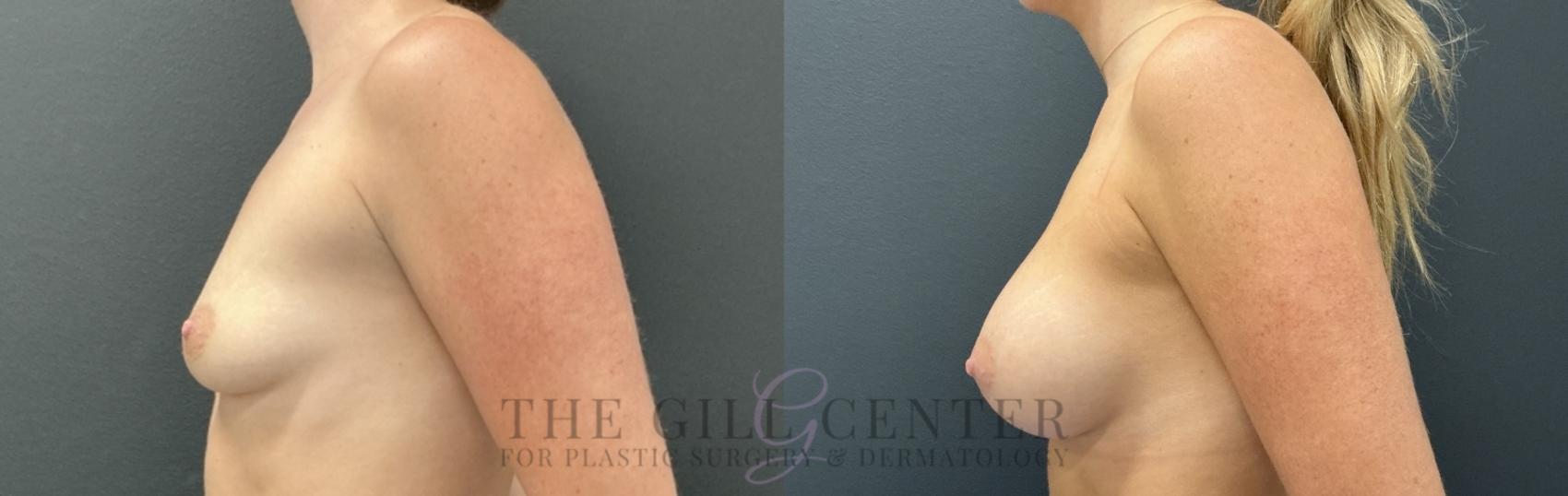 Breast Augmentation Case 757 Before & After Left Side | The Woodlands, TX | The Gill Center for Plastic Surgery and Dermatology