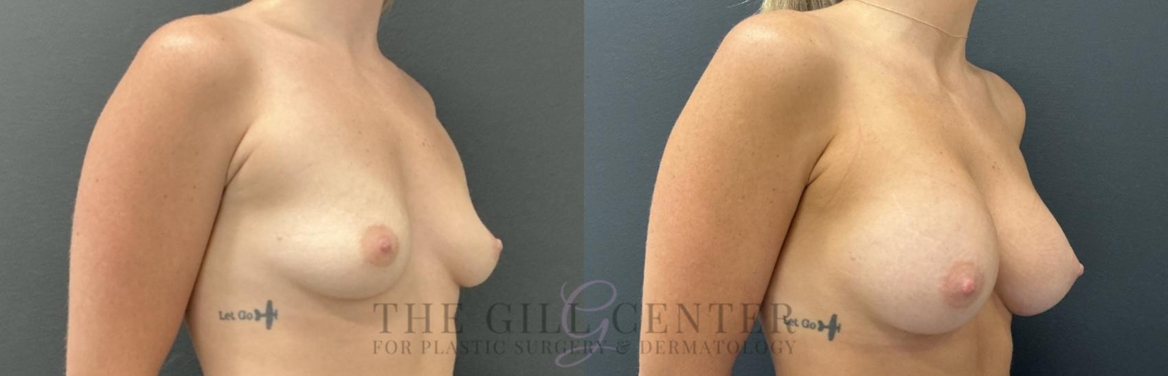 Breast Augmentation Case 757 Before & After Right Oblique | The Woodlands, TX | The Gill Center for Plastic Surgery and Dermatology