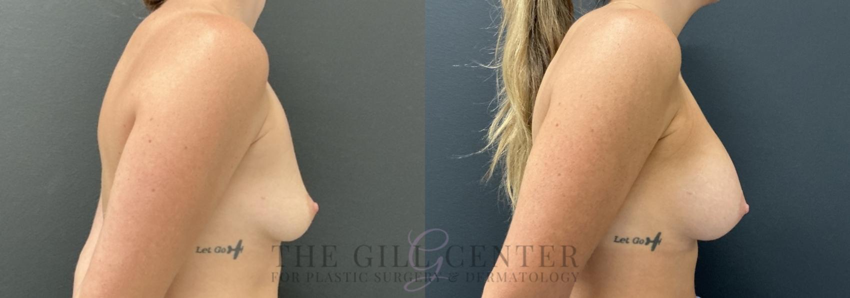 Breast Augmentation Case 757 Before & After Right Side | The Woodlands, TX | The Gill Center for Plastic Surgery and Dermatology