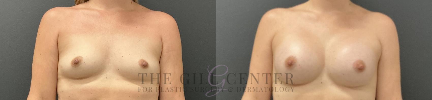 Breast Augmentation Case 815 Before & After Front | The Woodlands, TX | The Gill Center for Plastic Surgery and Dermatology