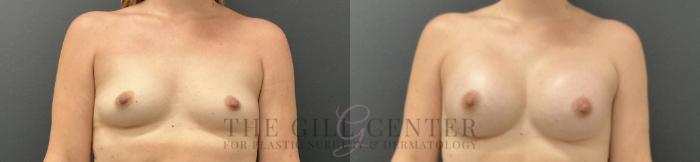 Breast Augmentation Case 815 Before & After Front | The Woodlands, TX | The Gill Center for Plastic Surgery and Dermatology