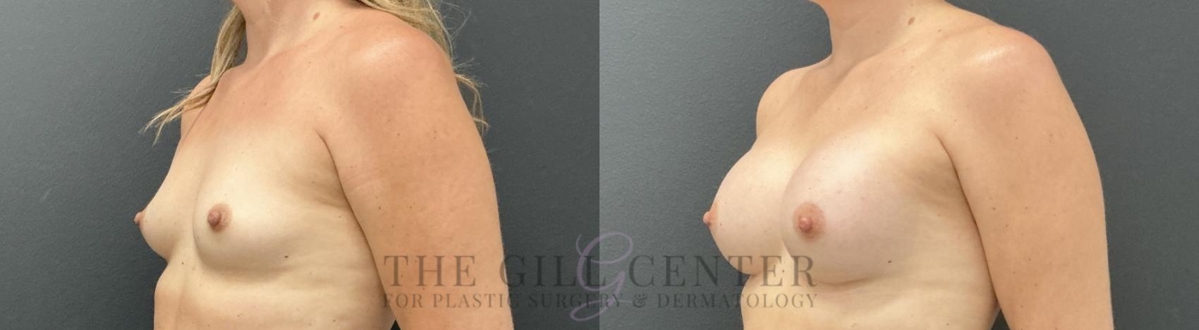 Breast Augmentation Case 815 Before & After Left Oblique | The Woodlands, TX | The Gill Center for Plastic Surgery and Dermatology