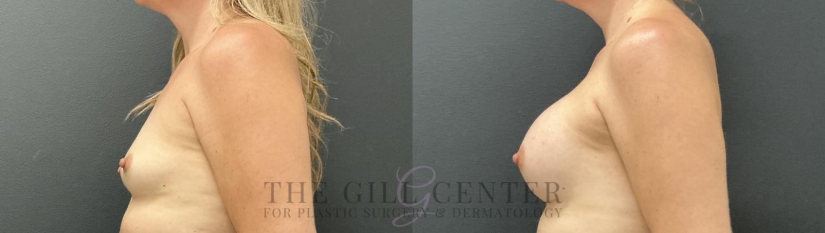 Breast Augmentation Case 815 Before & After Left Side | The Woodlands, TX | The Gill Center for Plastic Surgery and Dermatology