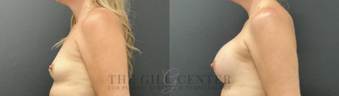 Breast Augmentation Case 815 Before & After Left Side | The Woodlands, TX | The Gill Center for Plastic Surgery and Dermatology
