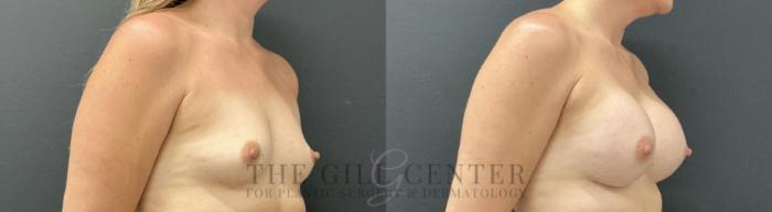 Breast Augmentation Case 815 Before & After Right Oblique | The Woodlands, TX | The Gill Center for Plastic Surgery and Dermatology